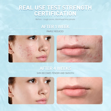 Load image into Gallery viewer, Salicylic Acid Acne Treatment- Skincare